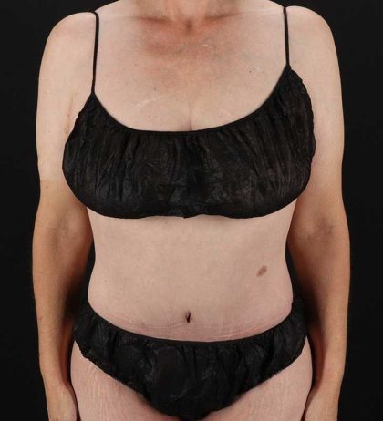 Circumferential Body Lift Before & After Patient #2624