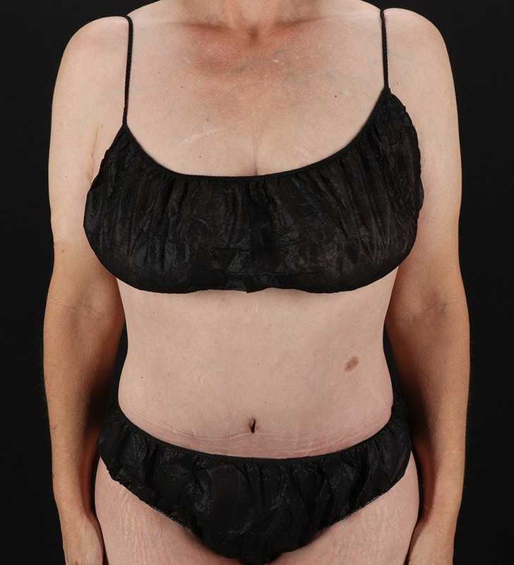 Circumferential Body Lift Before & After Patient #2624