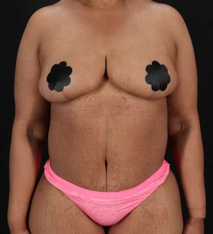Circumferential Body Lift Before & After Patient #2637