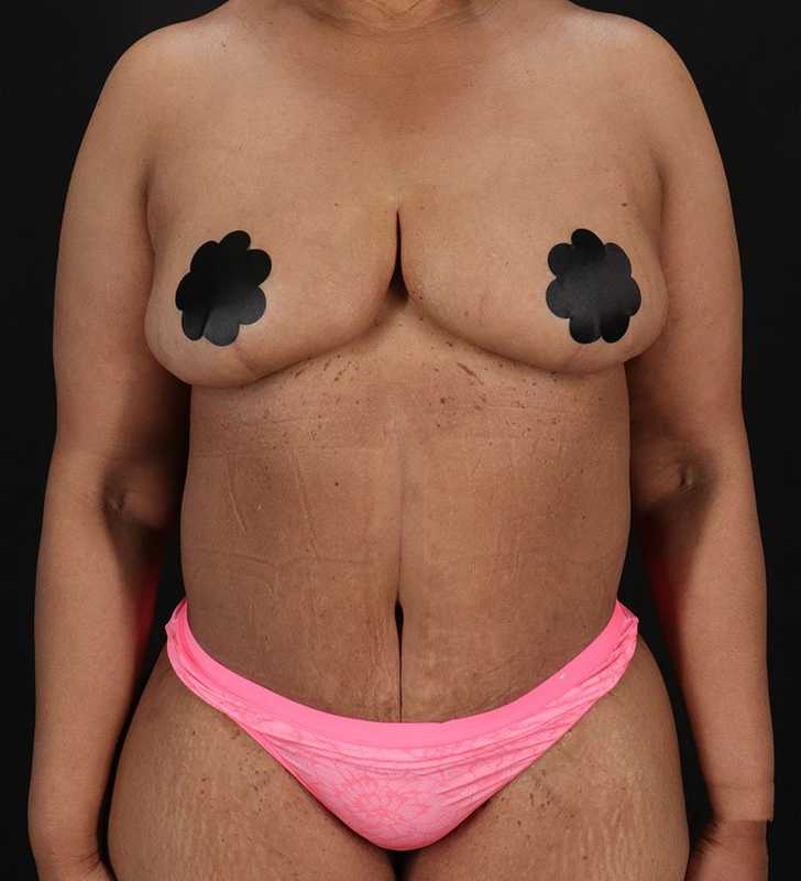Circumferential Body Lift Before & After Patient #2637