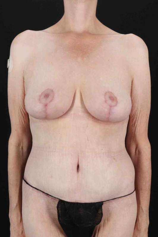 Circumferential Body Lift Before & After Patient #2663