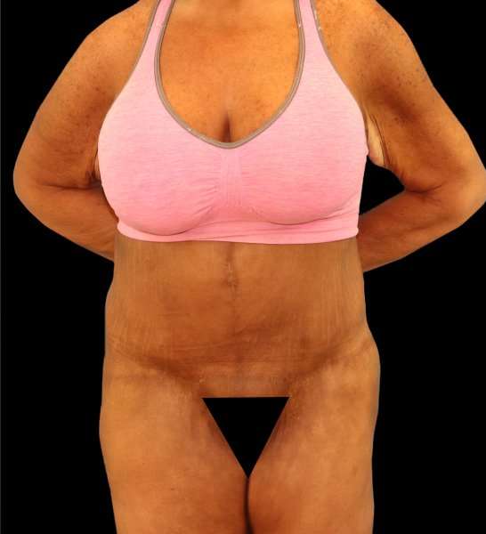 Fleur De Lis Circumferential Body Lift Before & After Patient #2674