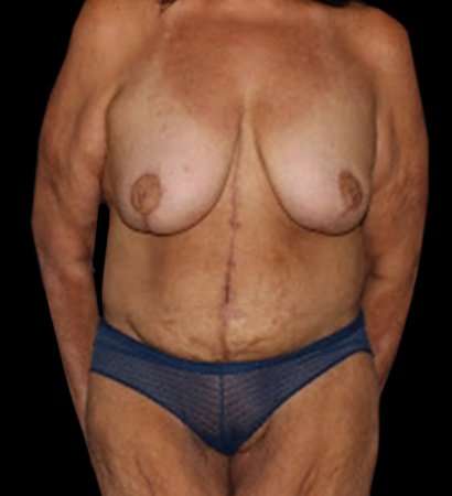 Fleur De Lis Circumferential Body Lift Before & After Patient #2685
