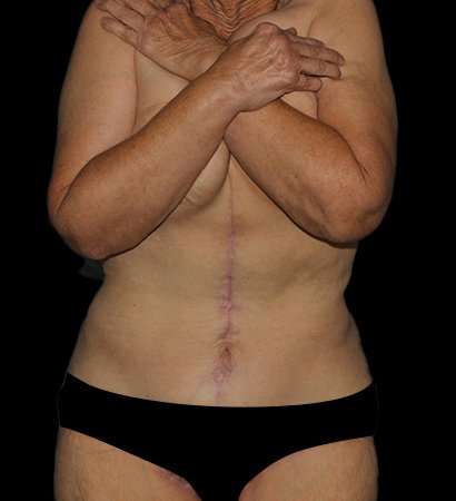 Fleur De Lis Tummy Tuck Before & After Patient #2692
