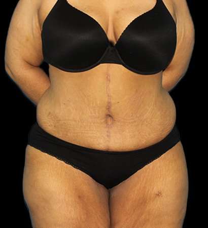 Fleur De Lis Tummy Tuck Before & After Patient #2703