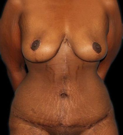Fleur De Lis Tummy Tuck Before & After Patient #2714