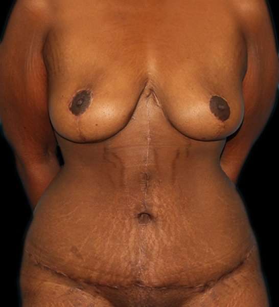 Fleur De Lis Tummy Tuck Before & After Patient #2714