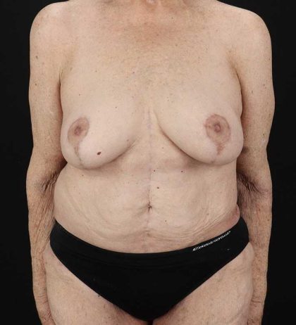 Fleur De Lis Tummy Tuck Before & After Patient #2727