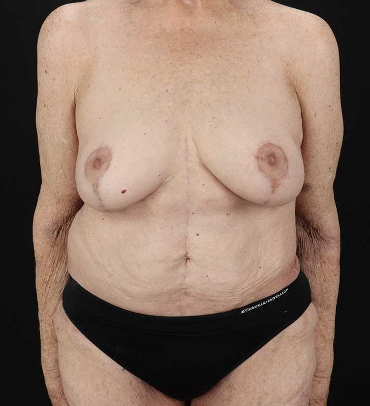 Fleur De Lis Tummy Tuck Before & After Patient #2727