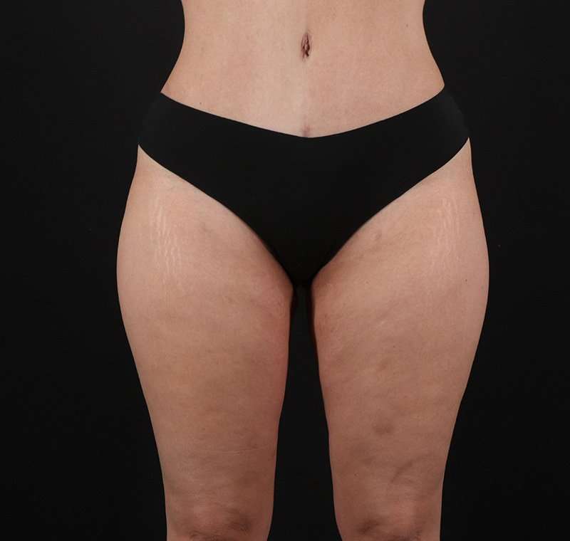 Liposuction Before & After Patient #2736