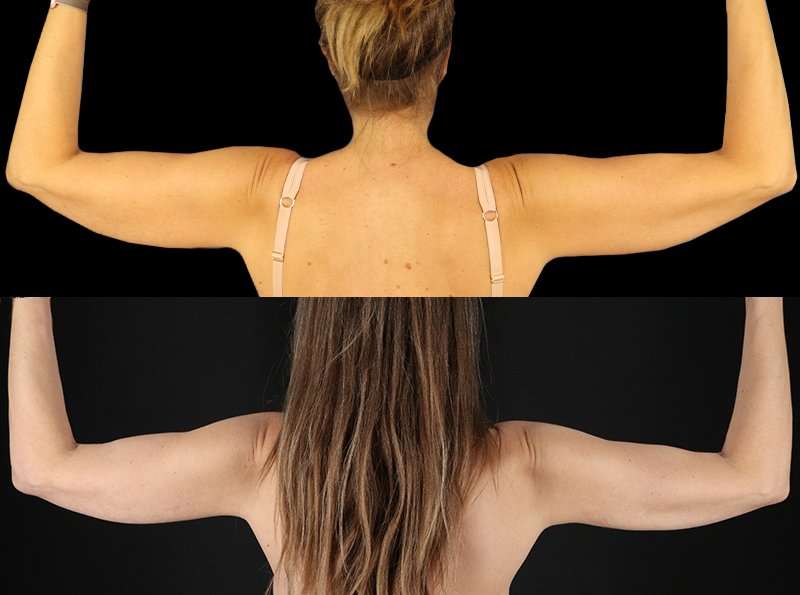 Liposuction Before & After Patient #2743