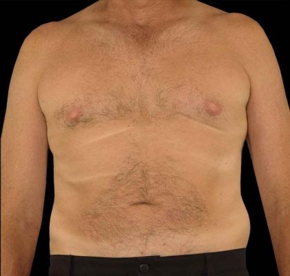 Liposuction Before & After Patient #2756