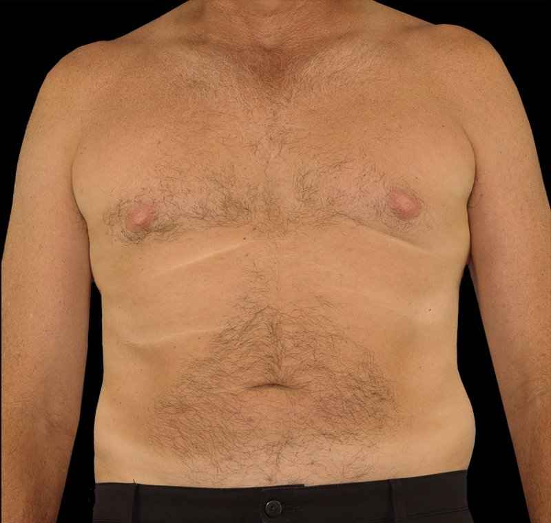 Liposuction Before & After Patient #2756