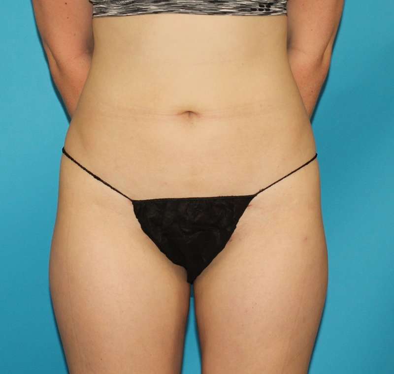 Liposuction Before & After Patient #2767