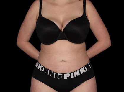 Liposuction Before & After Patient #2778