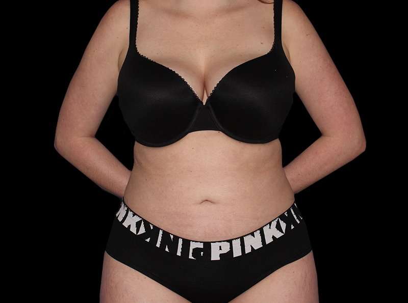 Liposuction Before & After Patient #2778