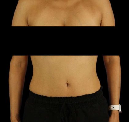 Liposuction Before & After Patient #2811