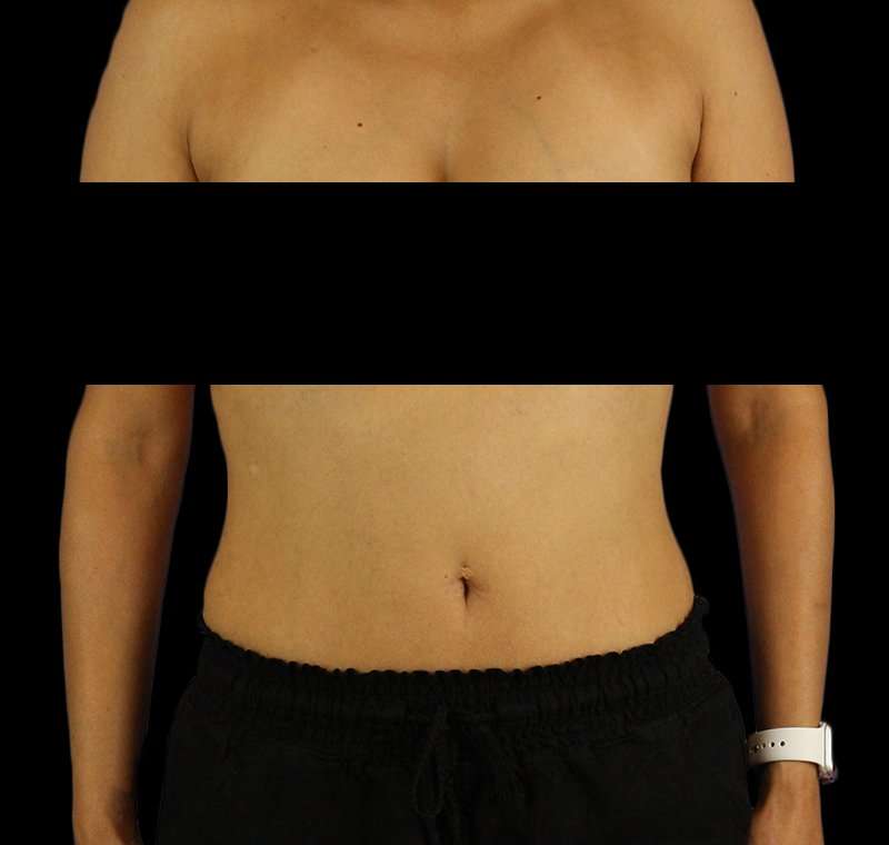 Liposuction Before & After Patient #2811