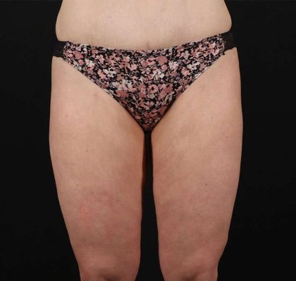 Liposuction Before & After Patient #2816