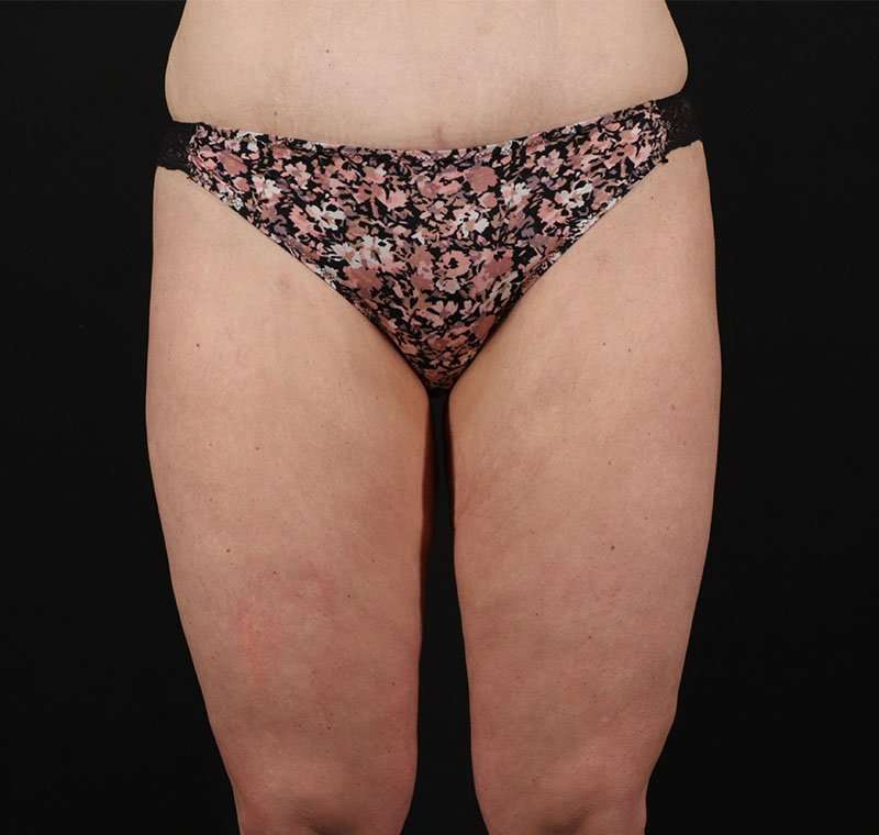 Liposuction Before & After Patient #2816
