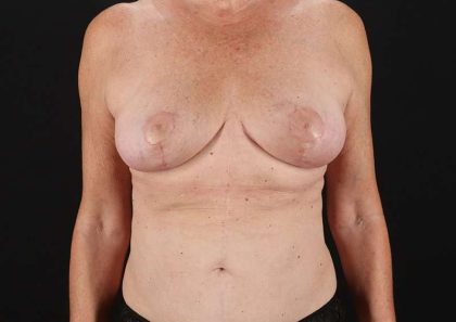 Breast Lift Before & After Patient #1061