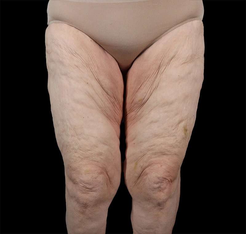 Liposuction Before & After Patient #2829