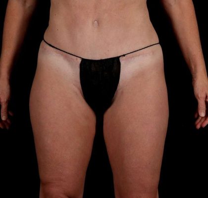 Liposuction Before & After Patient #2834