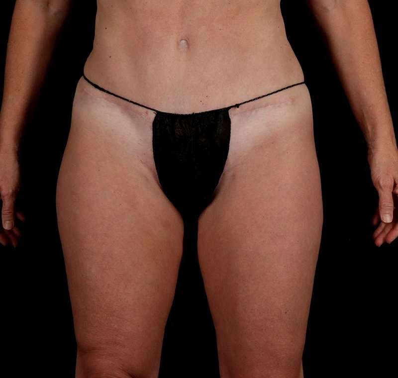 Liposuction Before & After Patient #2834