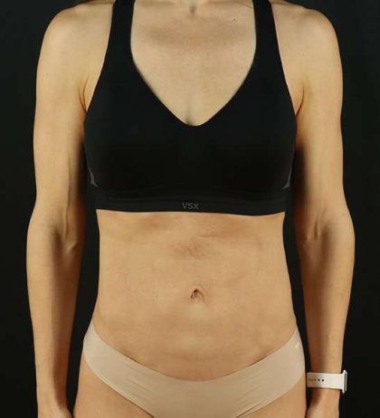 Mini Tummy Tuck Before & After Patient #2856