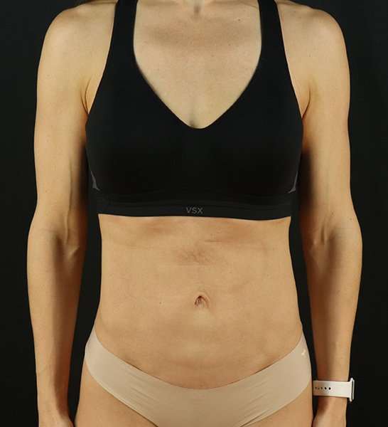 Mini Tummy Tuck Before & After Patient #2856