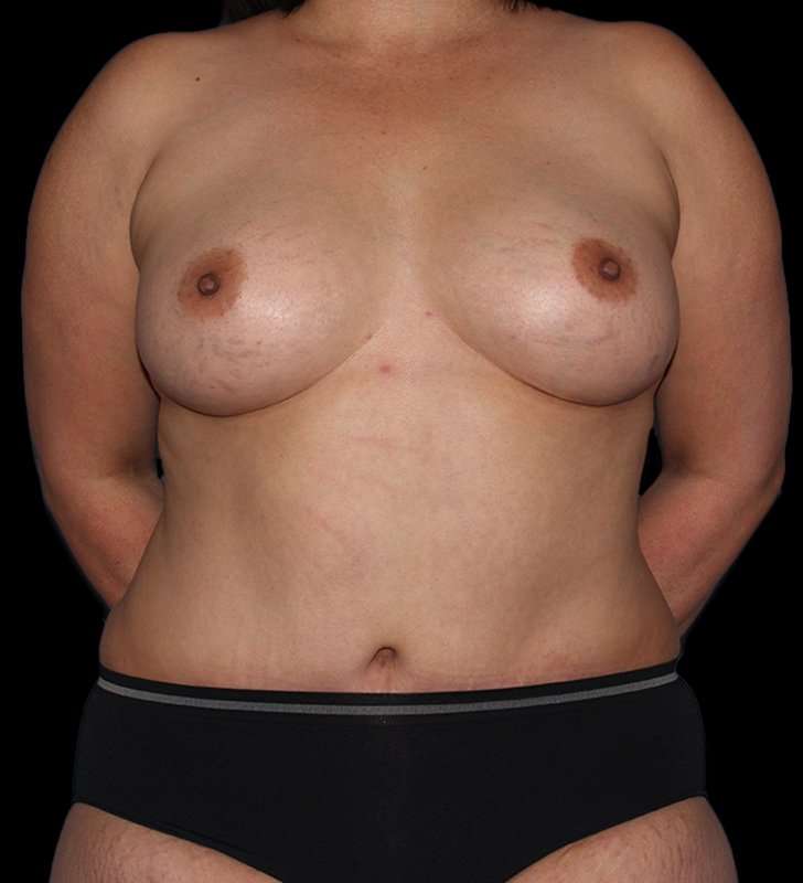 Mommy Makeover Before & After Patient #2878