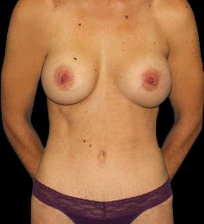 Mommy Makeover Before & After Patient #2889