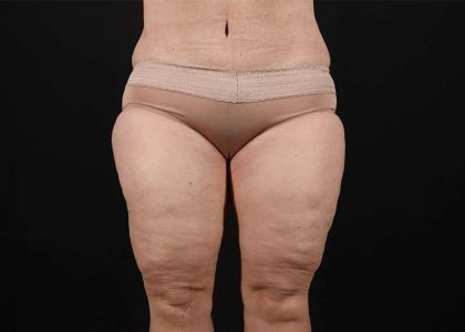 Thigh Lift Before & After Patient #2979