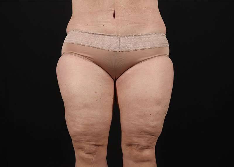 Thigh Lift Before & After Patient #2979