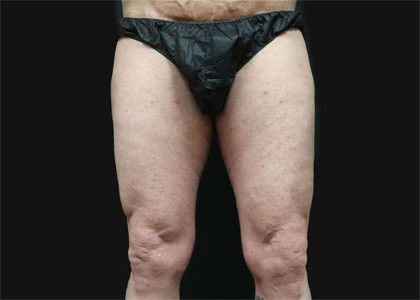 Thigh Lift Before & After Patient #2992