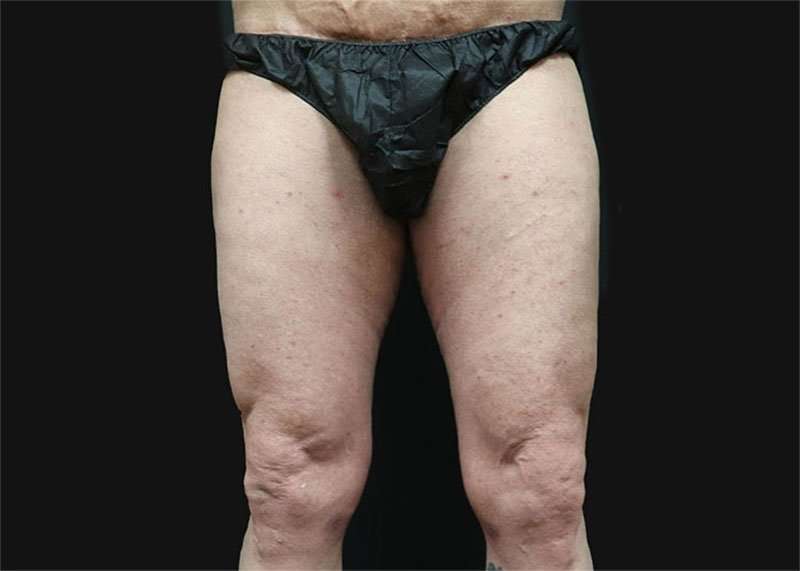 Thigh Lift Before & After Patient #2992