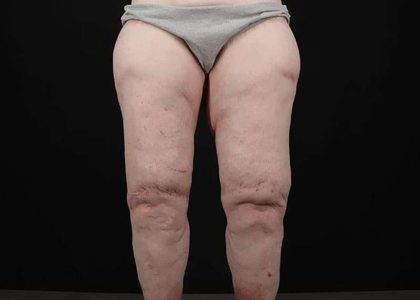 Thigh Lift Before & After Patient #3005