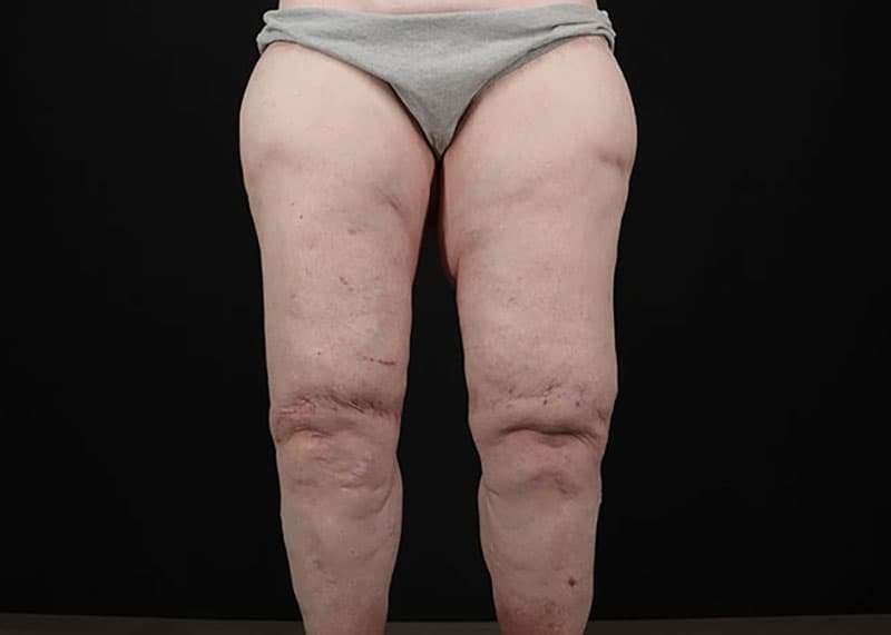 Thigh Lift Before & After Patient #3005