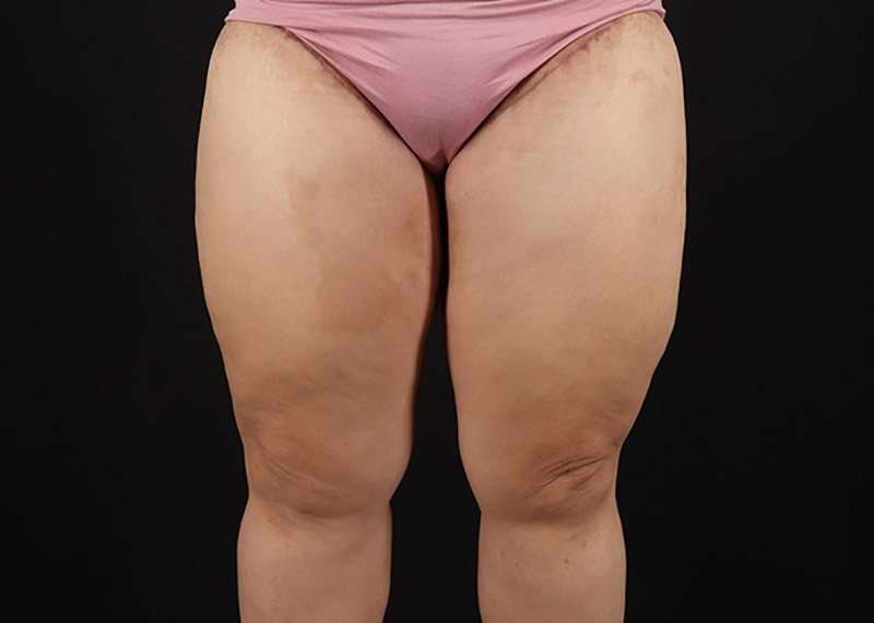Thigh Lift Before & After Patient #3018