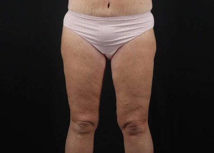 Thigh Lift Before & After Patient #3031