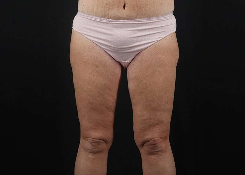 Thigh Lift Before & After Patient #3031