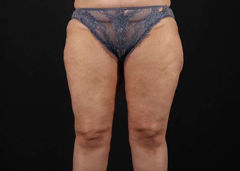 Thigh Lift Before & After Patient #3044