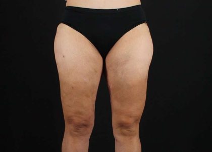 Thigh Lift Before & After Patient #3057