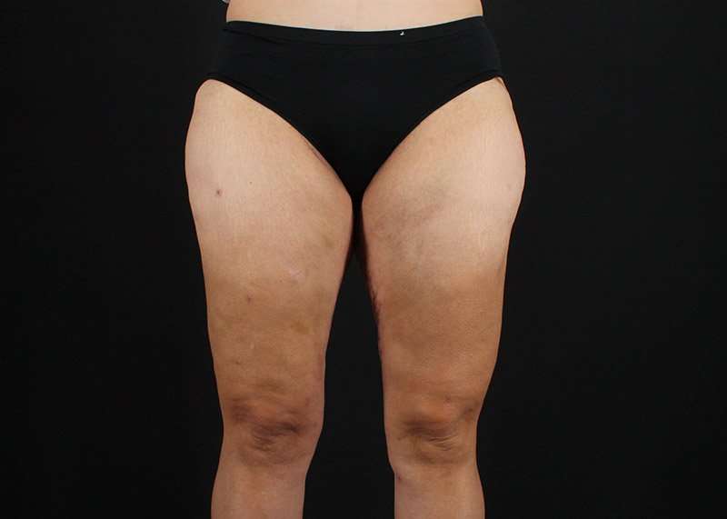 Thigh Lift Before & After Patient #3057