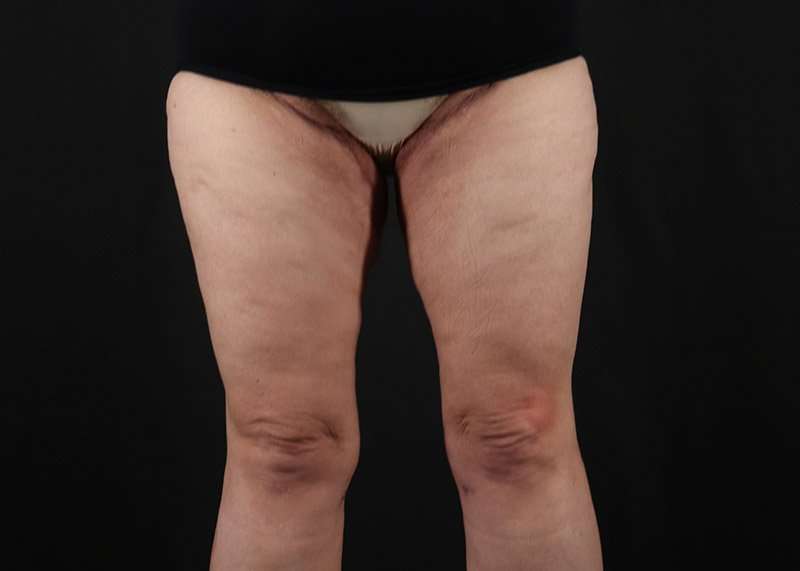 Thigh Lift Before & After Patient #3070