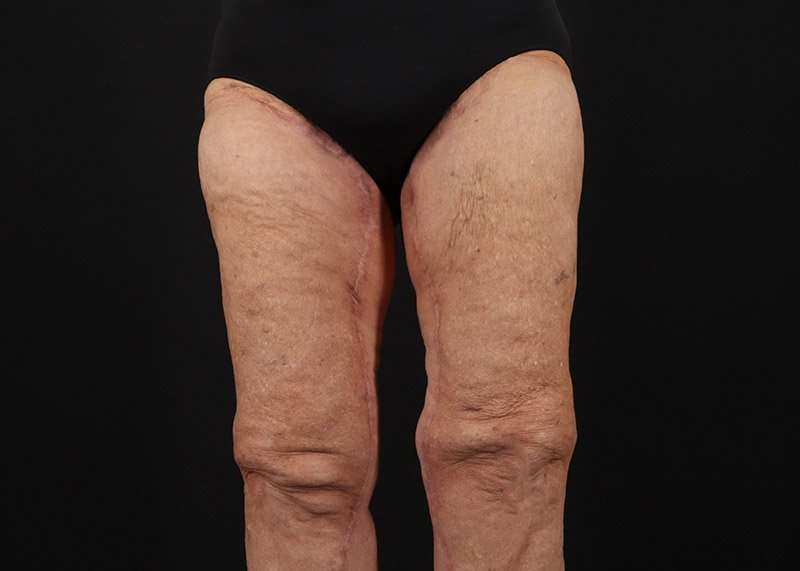 Thigh Lift Before & After Patient #3083