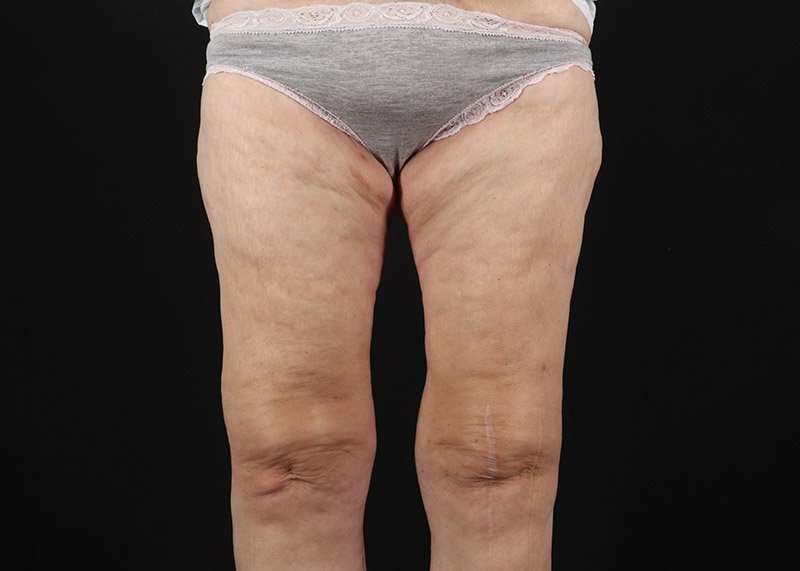 Thigh Lift Before & After Patient #3096