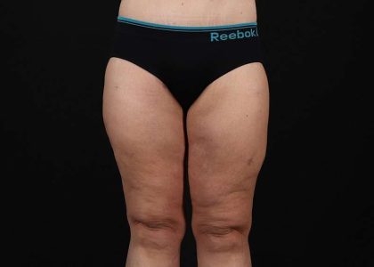 Thigh Lift Before & After Patient #3109
