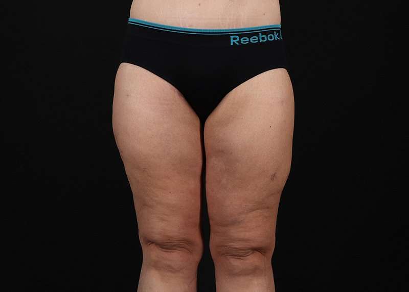Thigh Lift Before & After Patient #3109