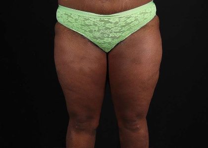 Thigh Lift Before & After Patient #3122
